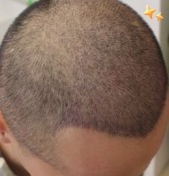 -大麦微针植发丨全国连锁