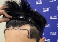 -碧莲盛·不剃发植发