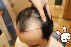 -大麦微针植发丨全国连锁