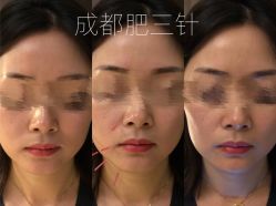 -肥三针腧穴瘦身馆