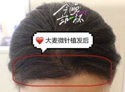 -大麦微针植发全国连锁