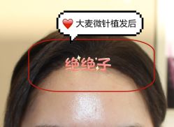 -大麦微针植发全国连锁