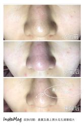 光SPA水氧＋果酸-光SPA科技美肤