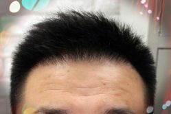 -大麦微针植发全国连锁