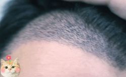 -大麦微针植发丨全国连锁