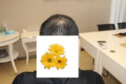 -大麦微针植发丨全国连锁