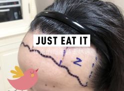 -大麦微针植发全国连锁