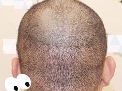 -大麦微针植发全国连锁