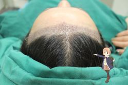 -大麦微针植发丨全国连锁