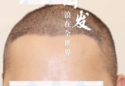 -大麦微针植发全国连锁