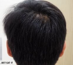 -大麦微针植发丨全国连锁