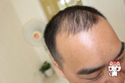 -大麦微针植发丨全国连锁