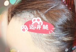 -大麦微针植发全国连锁