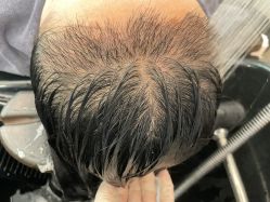 点击看大图 -碧莲盛·不剃发植发