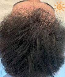 -大麦微针植发丨全国连锁