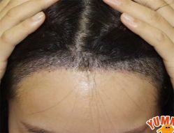 -大麦微针植发全国连锁