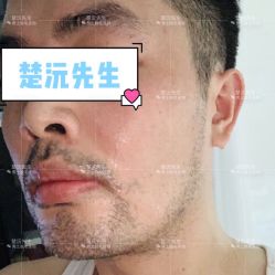 -楚沅先生专业男士脱毛连锁