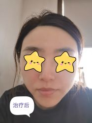体验后-针美汇欧邦医疗美容