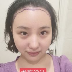 -碧莲盛·不剃发植发