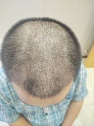 -大麦微针植发全国连锁