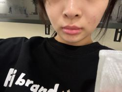 -海涛医疗美容·面部抗衰·注射美鼻