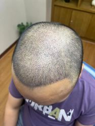 -大麦微针植发全国连锁