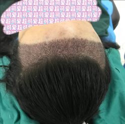 -大麦微针植发全国连锁