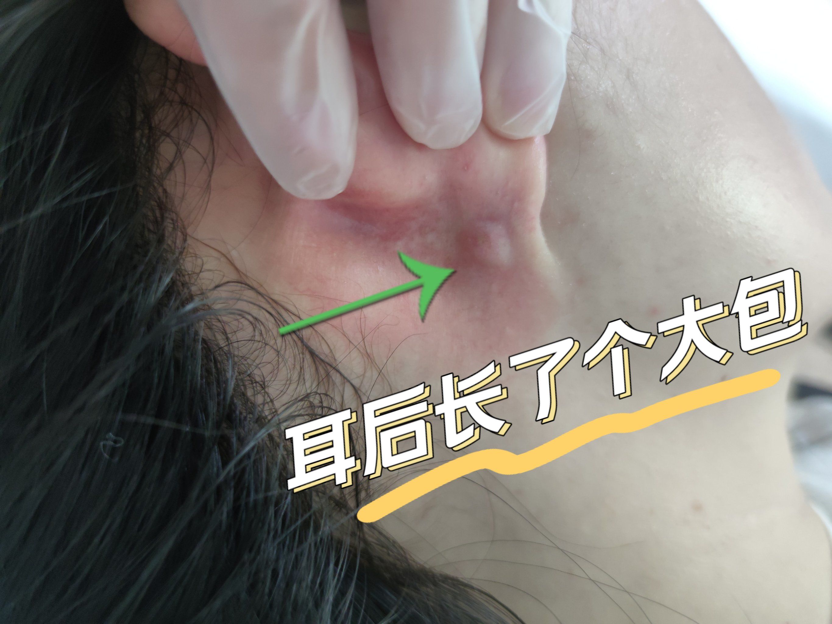 耳后长了个大包