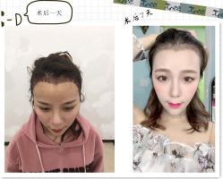 -大麦微针植发全国连锁