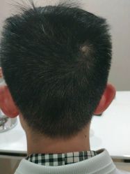 体验后-熙朵美学植发连锁