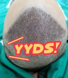 -大麦微针植发丨全国连锁