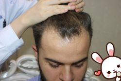 点击看大图 -大麦微针植发丨全国连锁