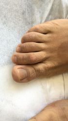-德哥灰指甲脚气甲沟炎跖疣护理