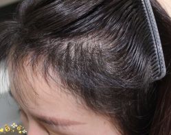 -大麦微针植发丨全国连锁