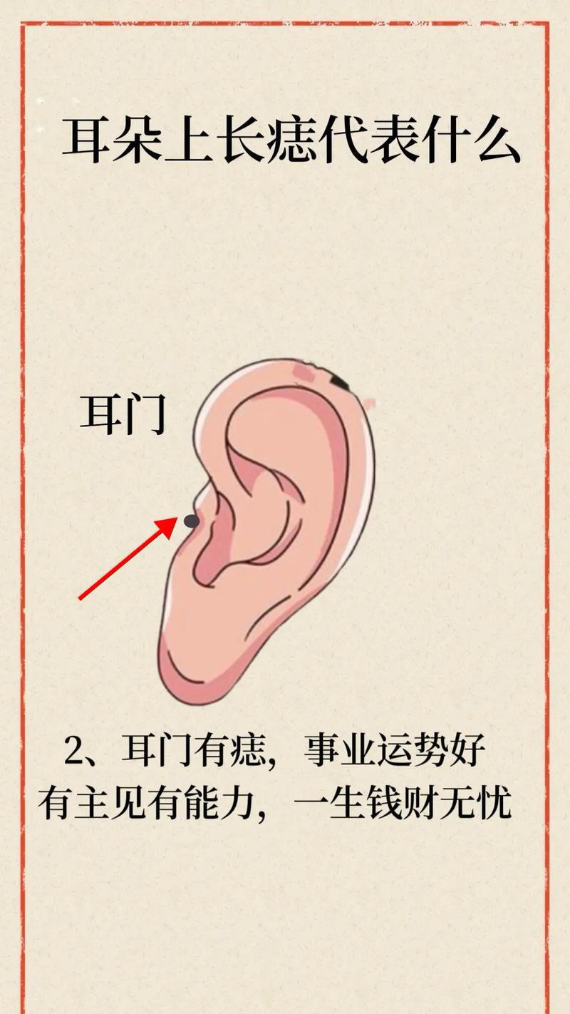 耳朵痣是福气还是祸事?自测❗