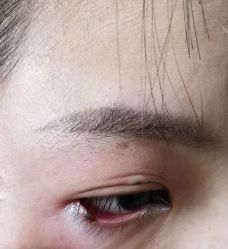 -北京美痣堂古方祛痣斑疣瘊