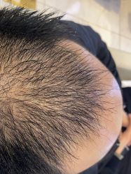 体验后-大麦微针植发丨全国连锁