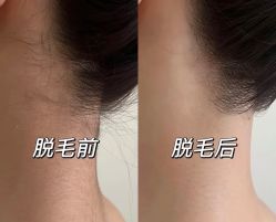 -薇兰专业脱毛连锁机构