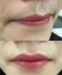 -薇兰专业脱毛连锁机构