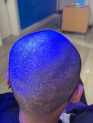 体验后-雍禾植发全国连锁