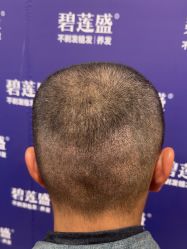 -碧莲盛·不剃发植发