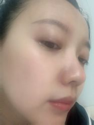体验后-叶美人医疗美容