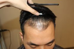 -大麦微针植发丨全国连锁