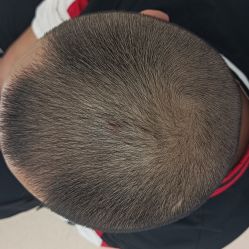 点击看大图 -大麦微针植发丨全国连锁