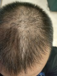 -碧莲盛·不剃发植发