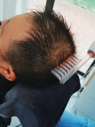 -大麦微针植发丨全国连锁