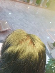 -碧莲盛·不剃发植发