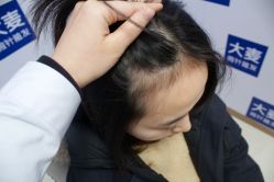 -大麦微针植发全国连锁