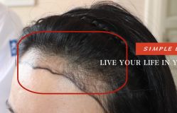 -大麦微针植发全国连锁