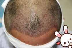 点击看大图 -大麦微针植发丨全国连锁